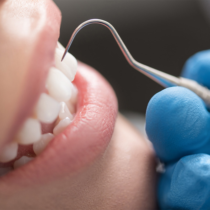 予防・クリーニング